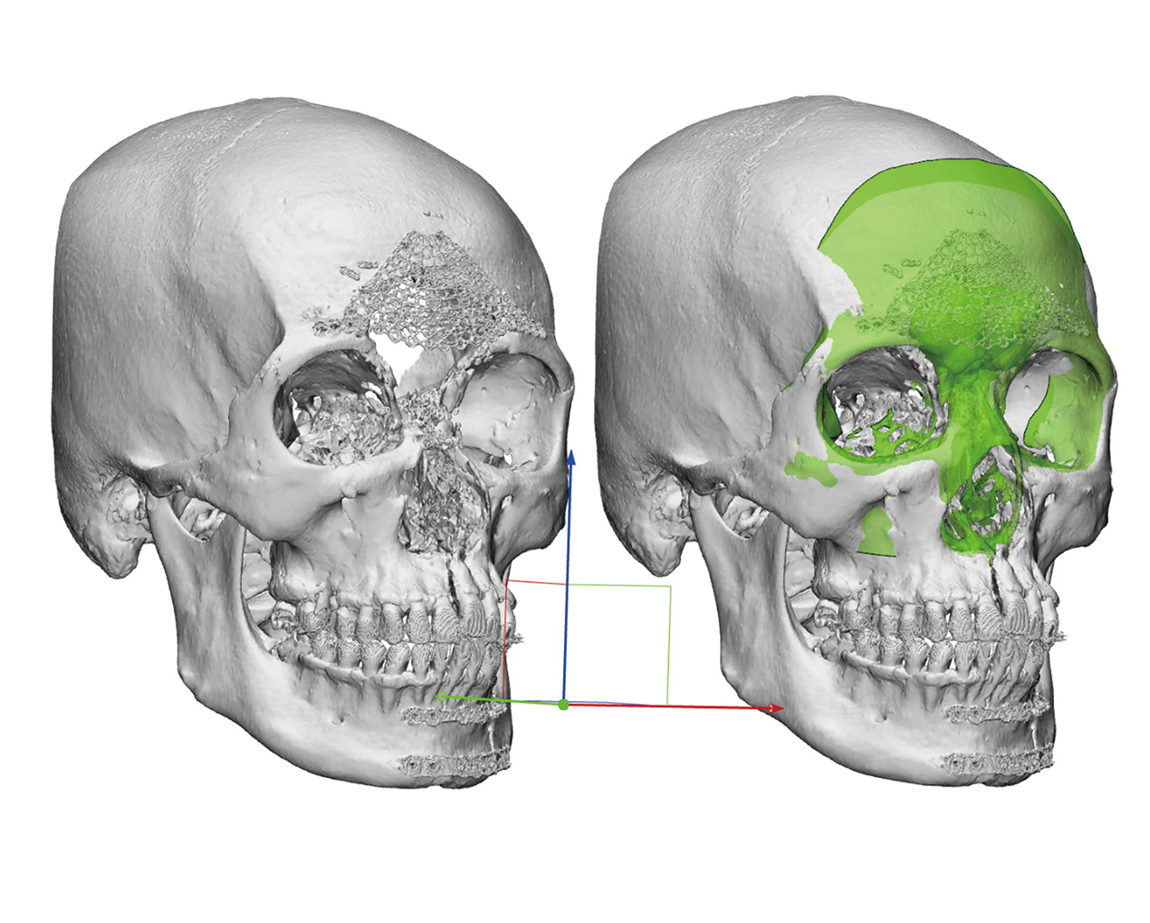 用資料庫中一位年輕男性的顱骨影像虛擬重建出病人缺損的骨骼